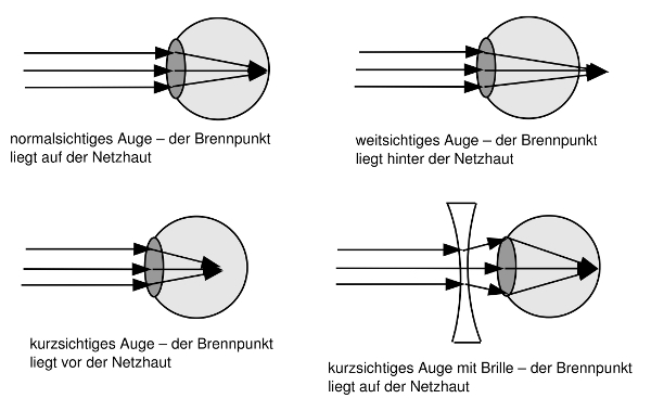 Grafik: Strahlengang im normalsichtigen, kurzsichtigen und weitsichtigen Auge